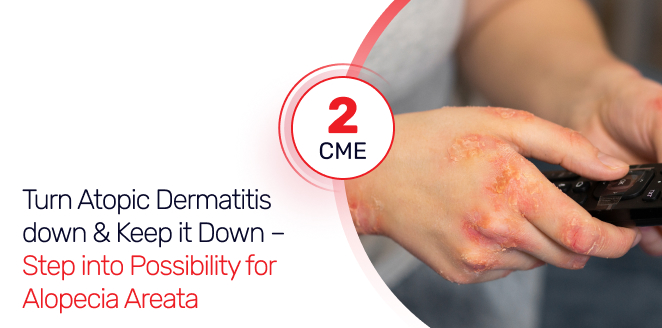 Turn Atopic Dermatitis down & Keep it Down – Step into Possibility for Alopecia Areata