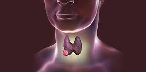 Thyroid cancer