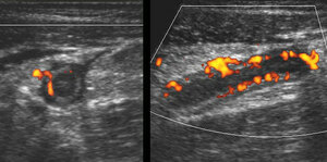 Abdominal US, a key for correct diagnosis