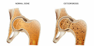 Osteoporosis: Latest Updates