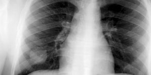 Common Congenital Lung Anomalies