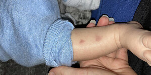 Management of a Child with Bruises