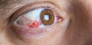 Common eye disease cases in FM