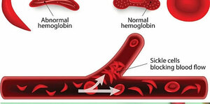 Evidence-Based Management of Sickle Cell Crisis