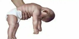 Approach to Floppy Infant