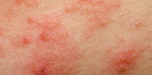 Approach to Ominous Skin Rash in the Emergency Department
