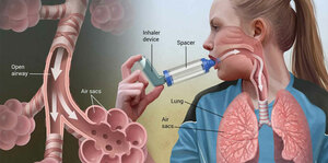 Management of Status Asthmaticus