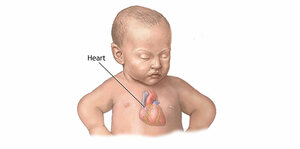 Update in Management of Heart Failure in Children