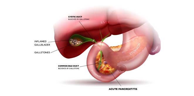 Acute cholecystitis