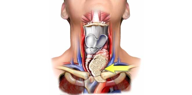 Thyroid tumor