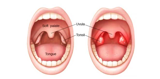 Tonsillitis