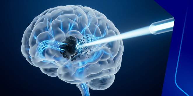 السكتة الدماغية